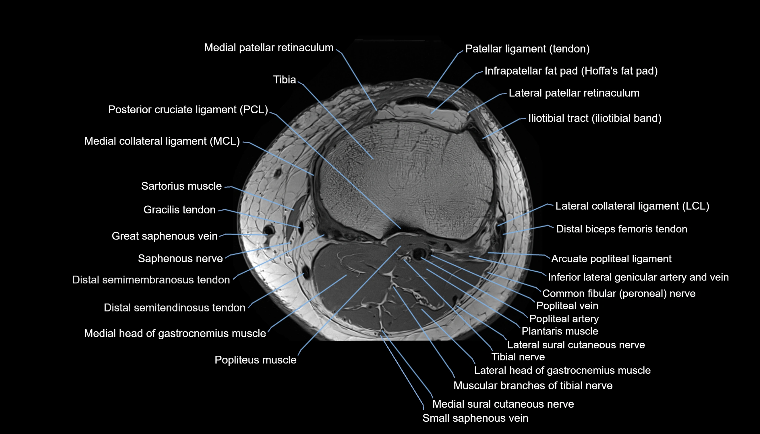 MRI knee  axial cross sectional anatomy 3T radiology  image-img-00001-00035.webp
